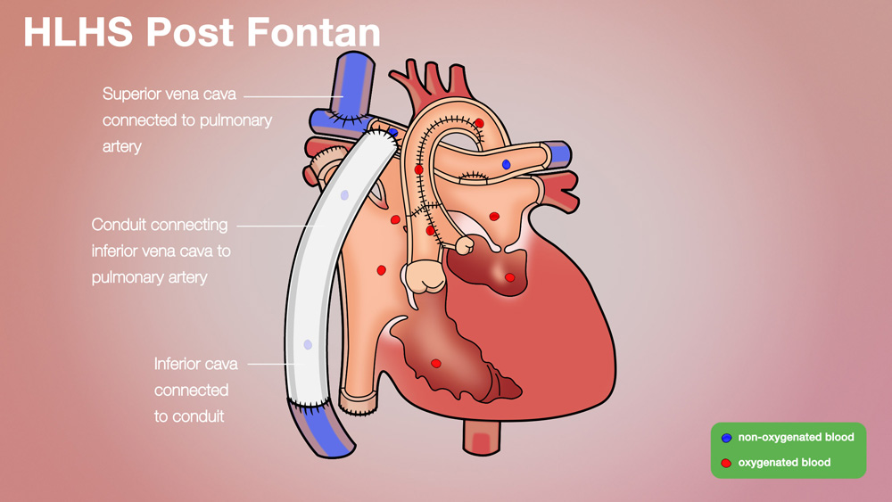 HLHS Post-Fontan Anatomical Heart