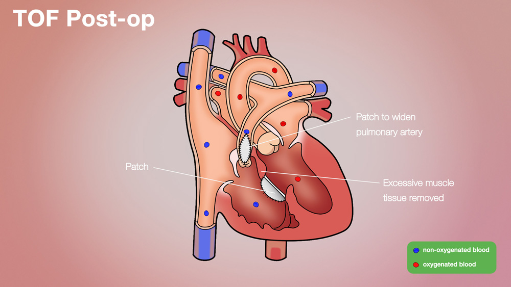 TOF Post-op Anatomical Heart